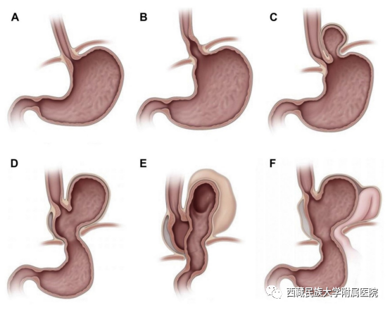 图：食管裂孔疝的分型 A.正常的胃食管连接部解剖 B.Ⅰ型滑动型食管裂孔疝 C. Ⅱ型食管裂孔疝,食管胃连接部位置正常，部分胃底通过裂孔进入胸腔 D. Ⅲ型食管裂孔疝, 食管胃连接部和胃底均通过裂孔进入胸腔 E. Ⅲ型食管裂孔疝, 食管胃连接部和全部胃进入胸腔 F. Ⅳ型食管裂孔疝, 疝囊内存在胃之外的其他器官（如结肠、脾脏或小肠）
